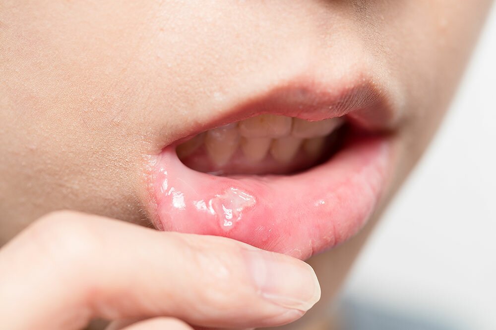 Cosa provoca le afte in bocca e come rimediare